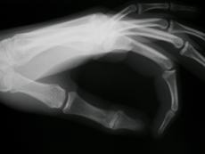 Xray of hand